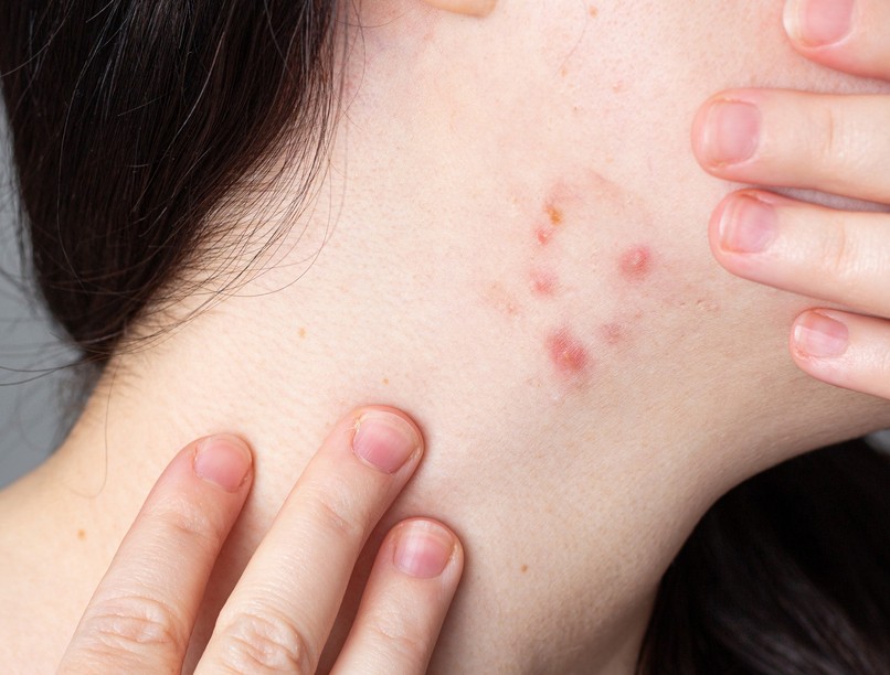 akne pattanás nyakon jelentése