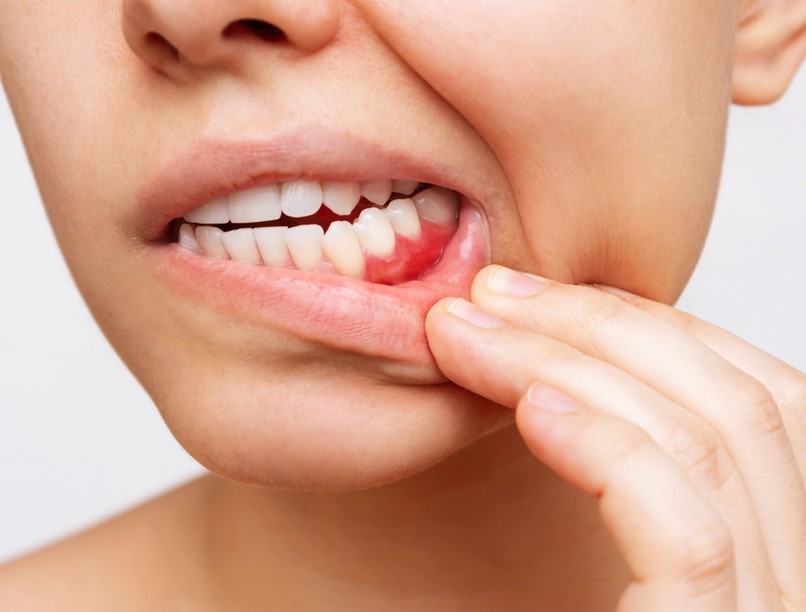 Vérző, érzékeny fogíny romló fogak daganat