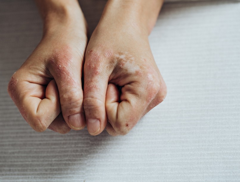 pikkelysömör kialakulás oka