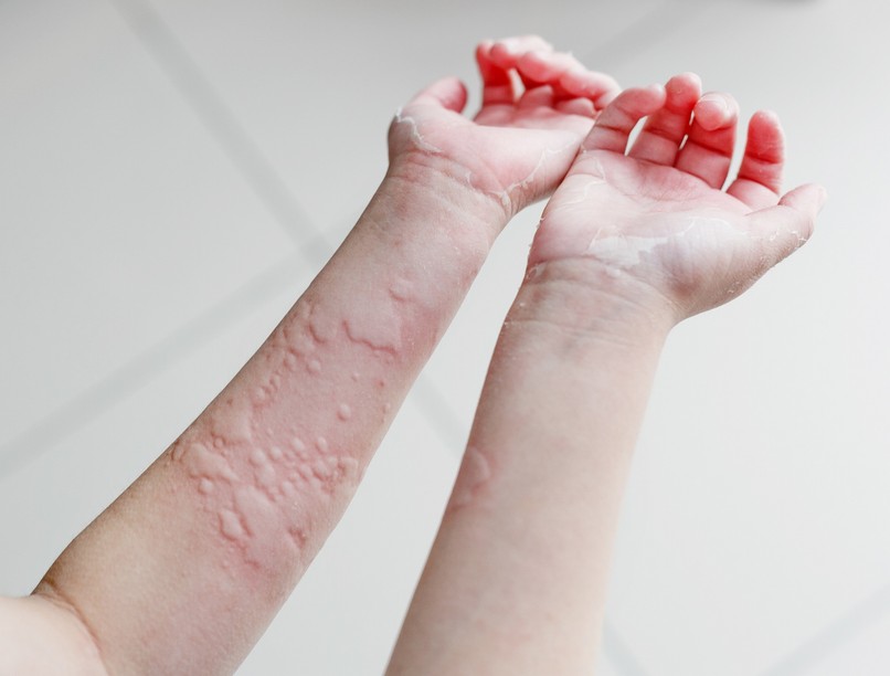 mi jó csalánkiütés ellen