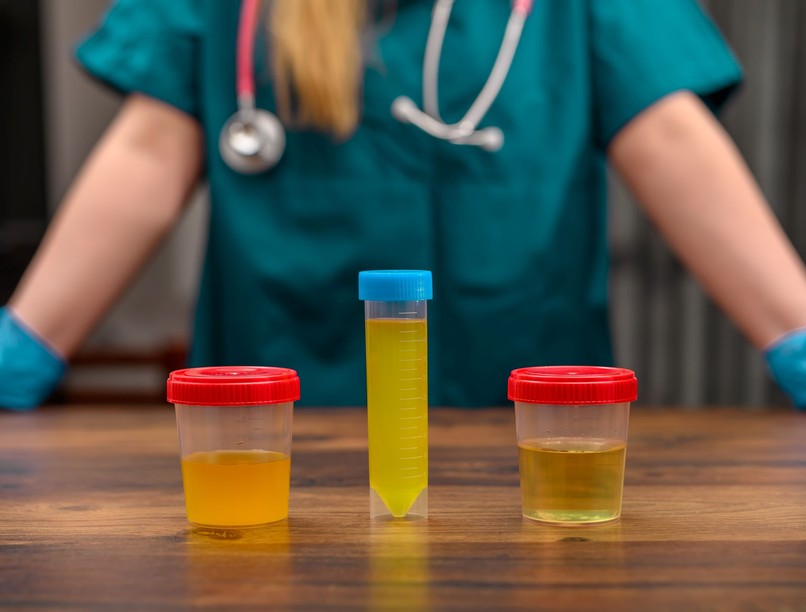 3 vészjósló jel a vizeletben