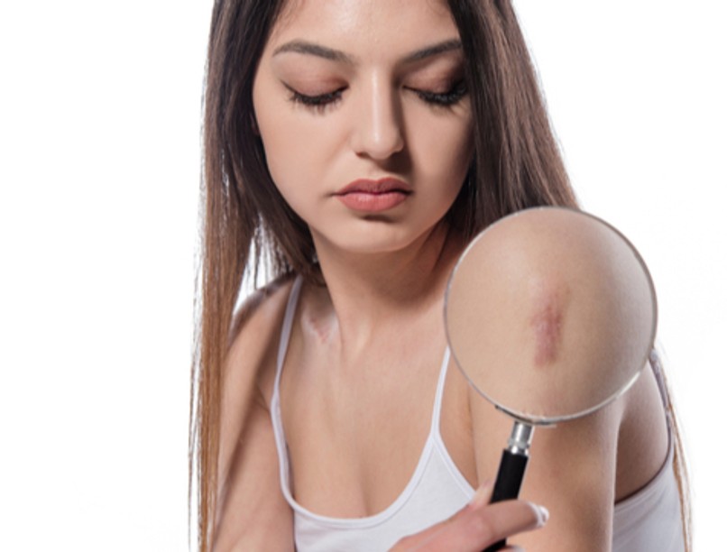 orvosi tetoválás, lézeres kezelés