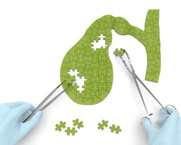 Epekő eltávolítás után - ezeket egye az elkövetkezendő napokban