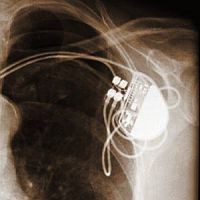 Jó hír: MRI-biztos pacemakert fejlesztettek ki