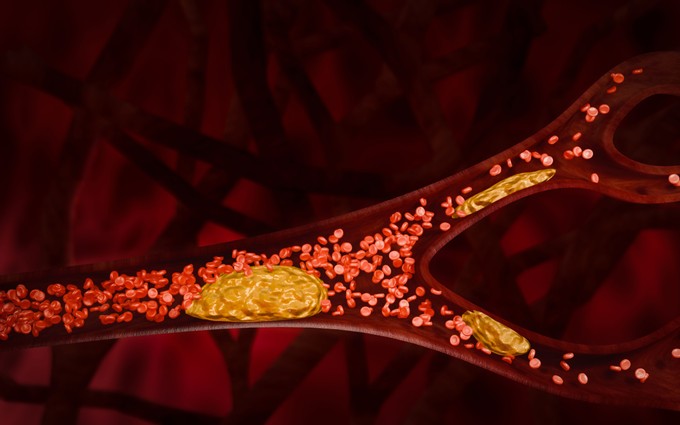 Plakkok az artériákban - ezek vezethetnek az erek elzáródásához című cikk nyitóképe