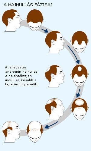 A hajhullás kezelése