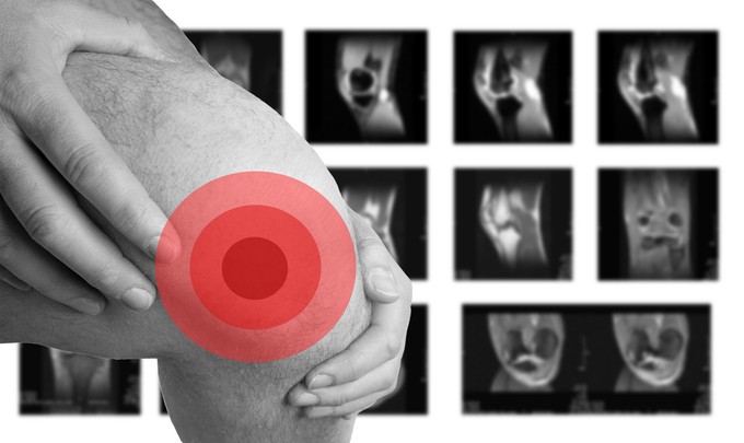 Porcmegújulás: valóban vissza lehet növeszteni a porcokat? című cikk nyitóképe