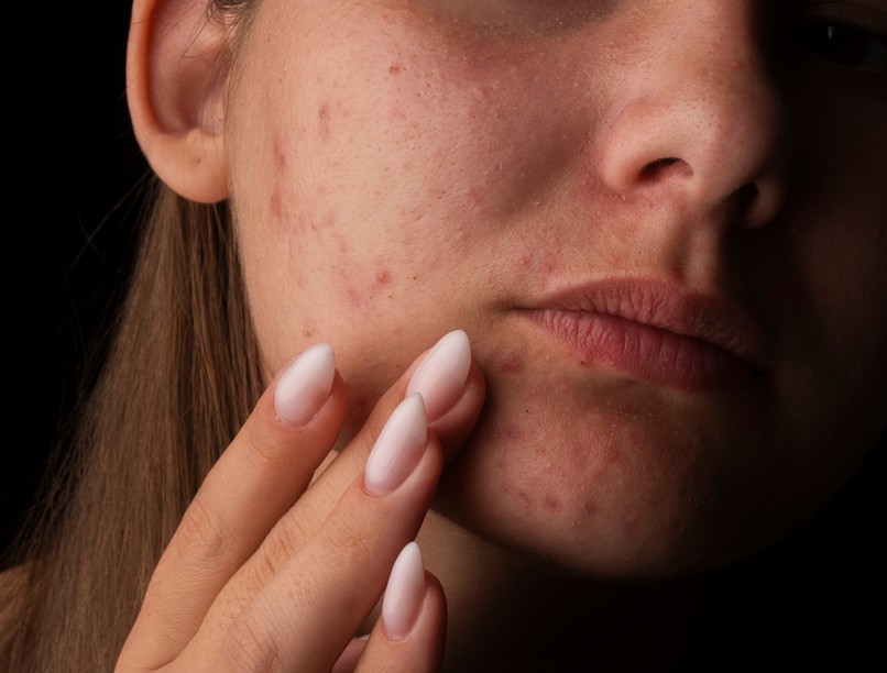 akné pattanás felnőttkor oka