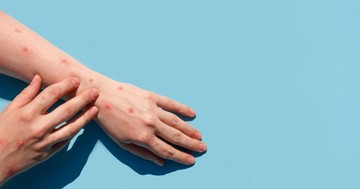 Majomhimlő vagy övsömör? Hasonlóak a tünetek, de van egy fontos különbség köztük