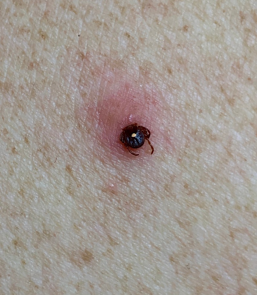 A kullancs kedveli a testhajlakokat (pl. hónalj, ágyék), gyakran bújik a fülek mögé, sőt, a hajban is menedékre talál. Amikor a kullancs a szájszervével sebet ejt a bőrön, érzéstelenítő váladékot juttat a nyílásba, ezért csak ritkán vesszük észre azonnal a támadót.