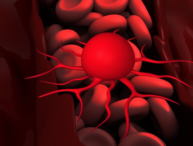 vastagbélrák vizsgálat szűrés PET CT