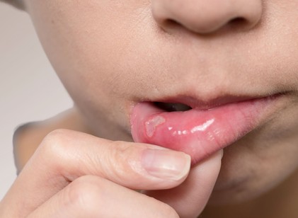 A B12-hiány első jelei a szájban jelenhetnek meg – ezekre figyeljen! című cikk nyitóképe