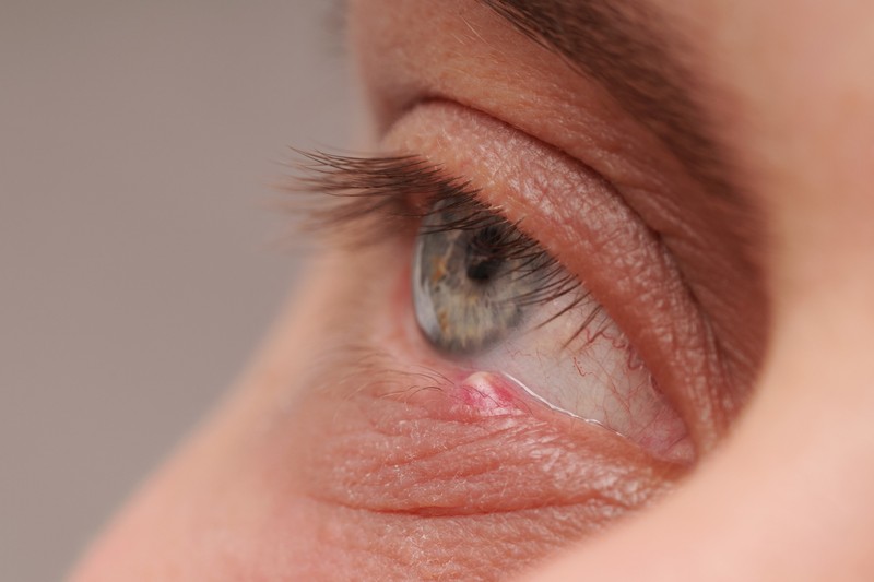 Mitől nőhet árpa a szemre, és hogyan szabadulhatunk meg tőle?