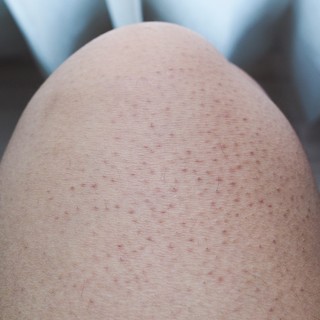 Csirkebőr, grízes bőr: a keratosis pilaris oka, tünetei és kezelése című cikk nyitóképe