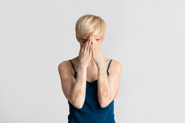 Csak a napsugárzás okozhat hiperpigmentációt? Így tüntethetjük el a barna foltokat