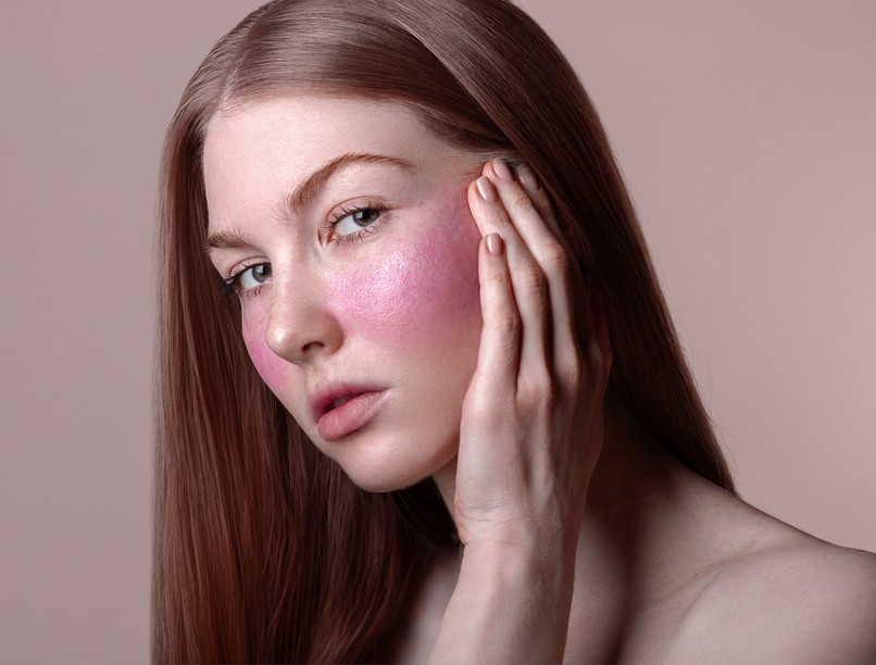 arc piros vörös lupus rosacea autoimmun betegség