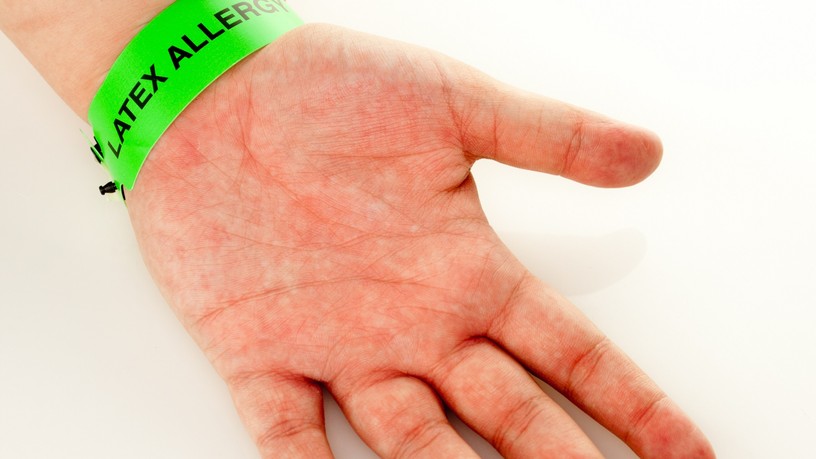 Latex allergia