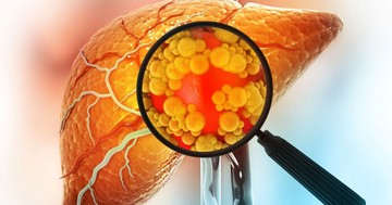  Erre a 6 dologra figyeljen, ha zsírmája van, hogy ne legyen még nagyobb baj! 