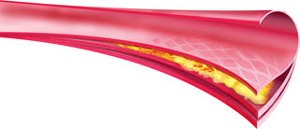 Atherosclerosis (érszűkület)