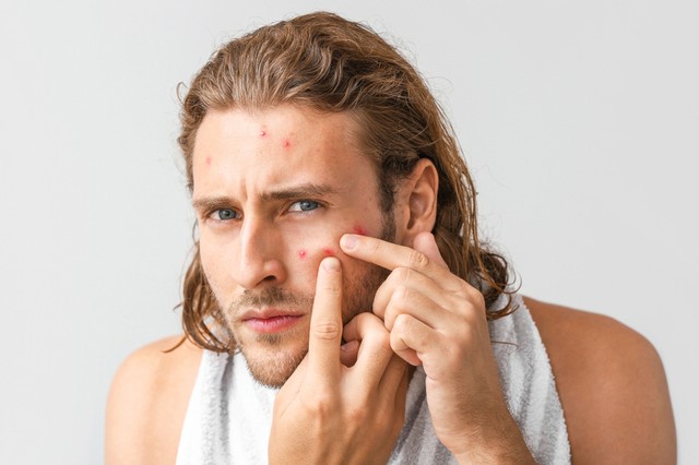 Ezek a módszerek segíthetnek a férfiak pattanásos bőrén