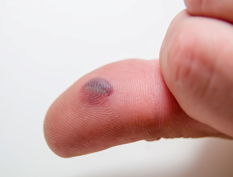 fájdalmas vérhólyag mennyi idő alatt múlik el