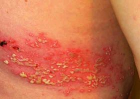 Az övsömör elleni védőoltás haszna