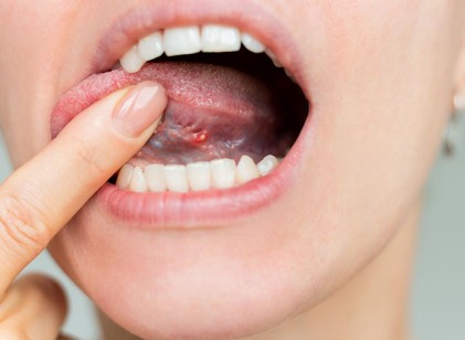 A nyelve is árulkodhat: 9 szájüregi tünet, amely B12-vitamin-hiányra figyelmeztethet című cikk nyitóképe