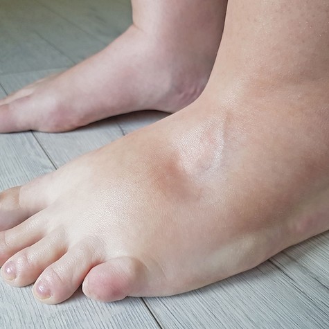 Nyomja meg pár másodpercre a bokáját: ha mélyedés marad utána, szívbetegség is állhat a háttérben című cikk nyitóképe