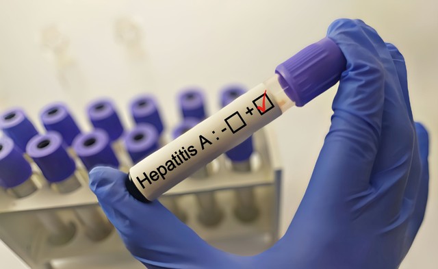 Nem csitul a hepatitis A fertőzés az országban