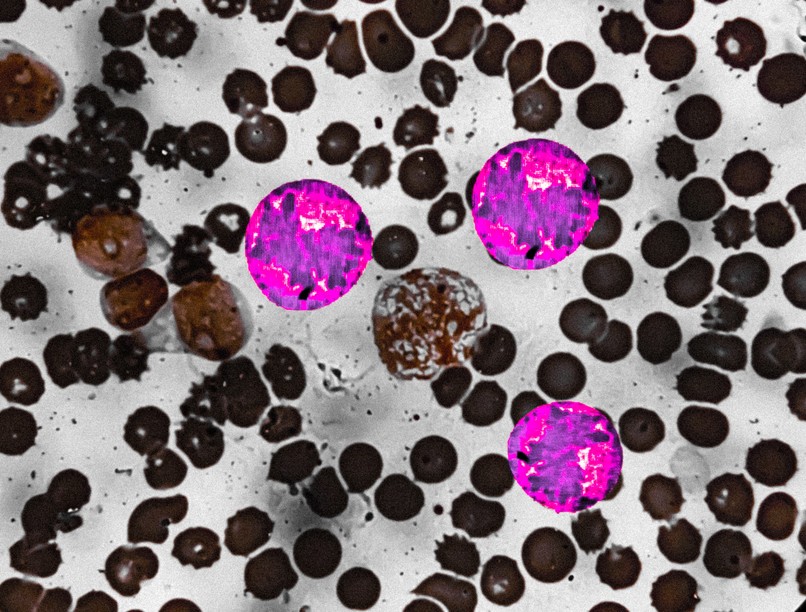 Trombocitózis, trombocitémia