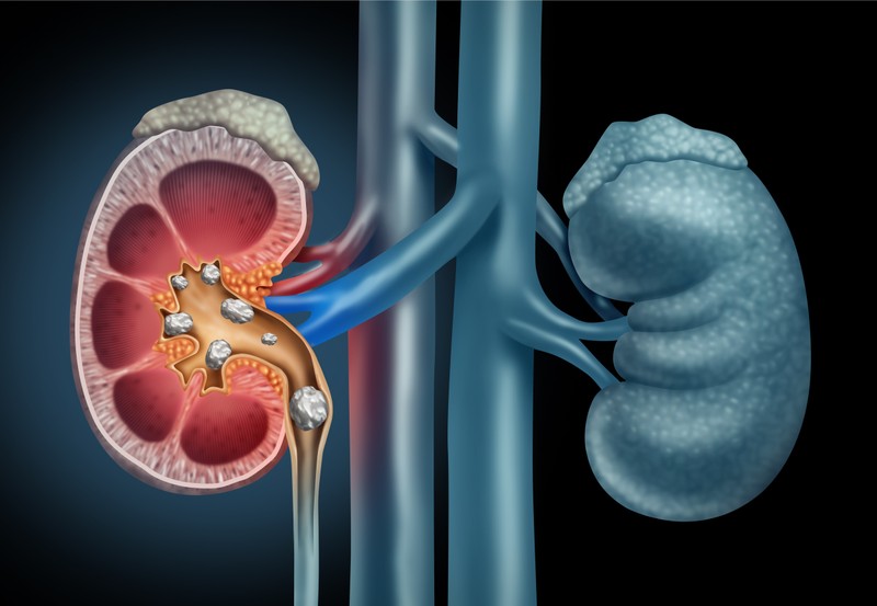 Ez a világ legnagyobb és legnehezebb veseköve: nem hiszi el mekkora