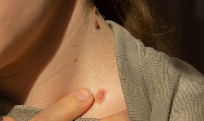 Időben felismerheti a bőrrákot, ha követi ezt az egyszerű módszert! című cikk nyitóképe