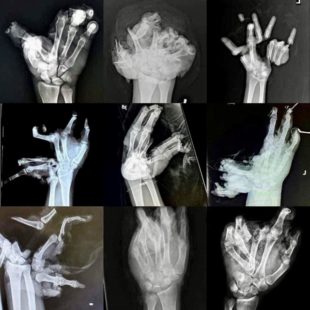 Öncsonkítás lehet belőle: ugye ön sem petárdázik szilveszter éjjel?