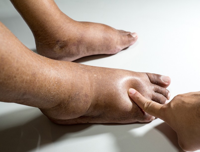 bedagadt láb ujjak boka vizesedés tünetei