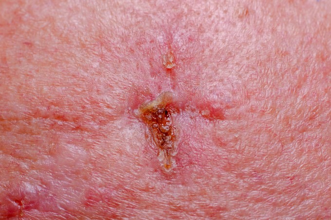 Kezdetben egyszerű sebnek tűnhet, pedig bőrrák: szokatlan tünetek is figyelmeztethetnek basaliomára című cikk nyitóképe