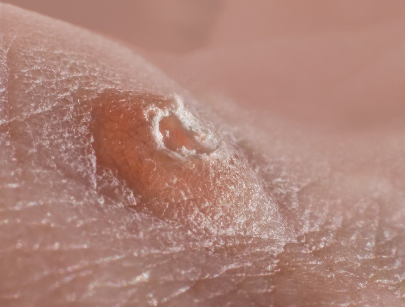 HPV vírus teszt kezelés gyógyítás baktériumflóra