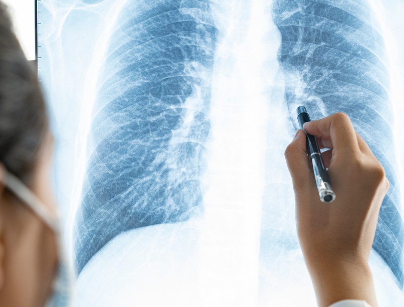 koronavírus, tüdőgyulladás, covid