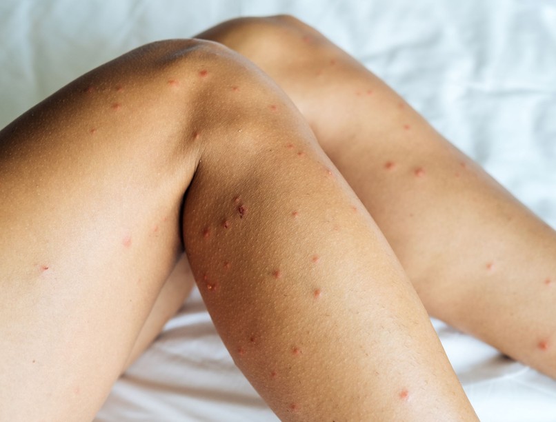 ágyi poloska, ágyi poloska irátsa, ágyi poloska csípése, irtás, vegyszer