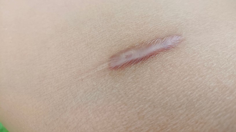 keloid jelentése