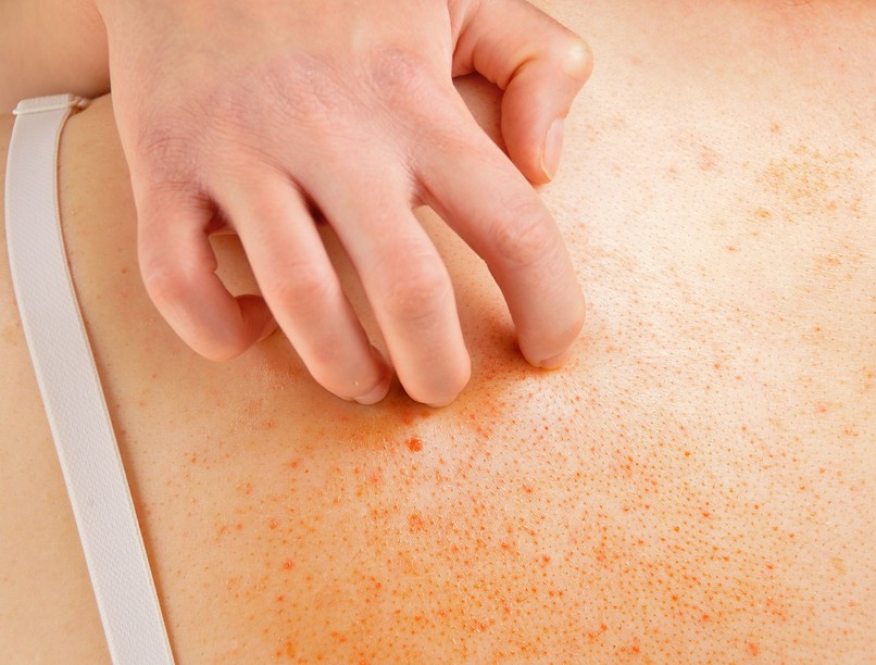 Mit jelent, ha viszket az anyajegy?