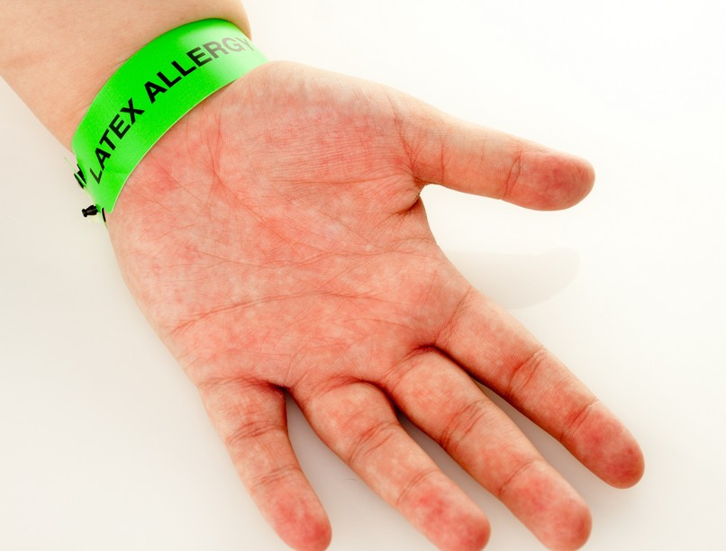 Latex allergia