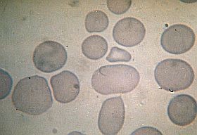 A vérszegénység és fontosabb típusai (2. rész)