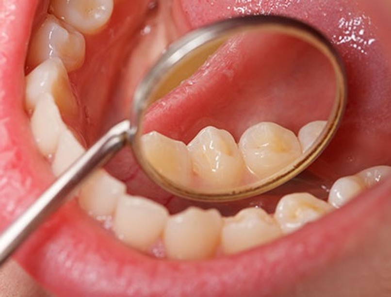 oral-cancer-screening