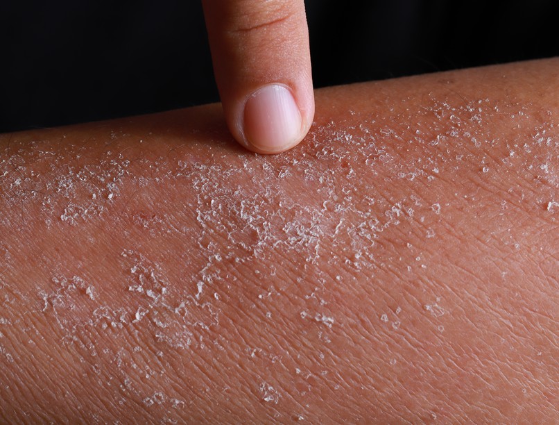 Gombás bőrkiütés