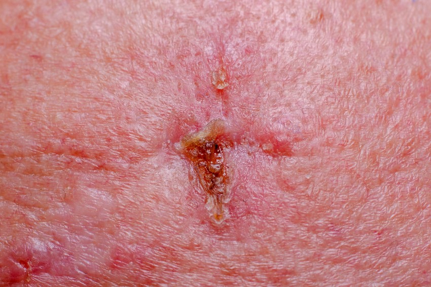 A basalioma az leggyakoribb bőrdaganat fajta, amely leginkább a napfénynek kitett testfelszíneken alakul ki.