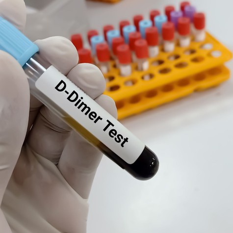 Vérvételi eredmény, ami sokakat megijeszt: mikor kell komolyan venni a magasabb D-dimert? című cikk nyitóképe