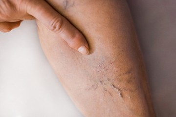 Mi a visszértágulat, és mi a legjobb módszer ellene?