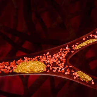 Plakkok az artériákban - ezek vezethetnek az erek elzáródásához című cikk nyitóképe