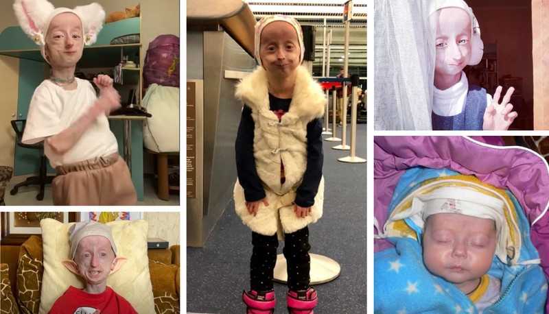 Anja Dobbie: így él egy extra gyorsan öregedő lány