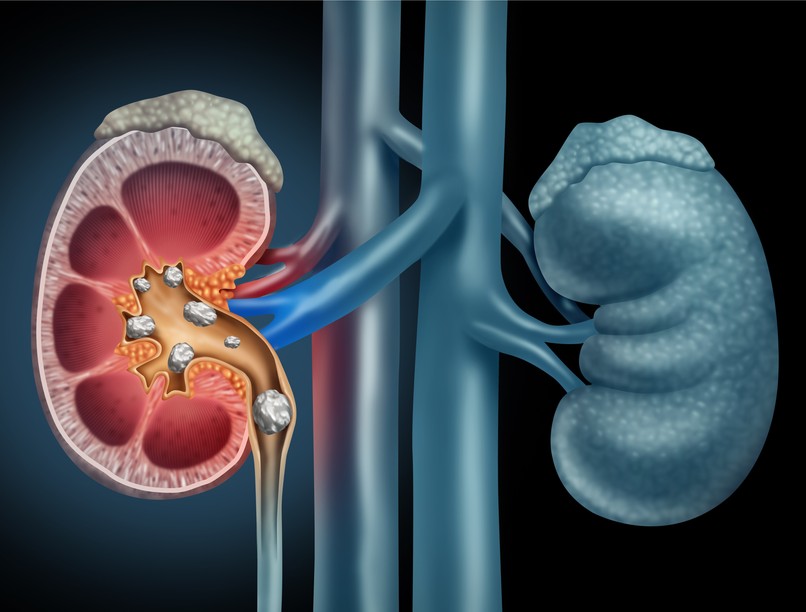 vesekő, diéta, étrend, vesebetegség
